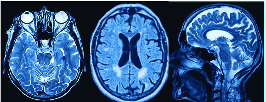 MRI brain scans